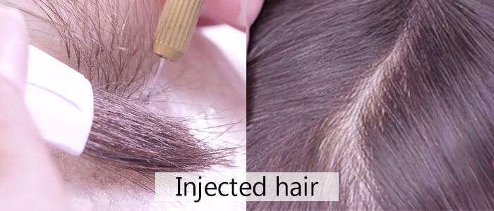 Know All About 'Return Hair' on Hair Replacement Systems