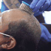 cleaning-the-scalp-with-a-fingernail-brush