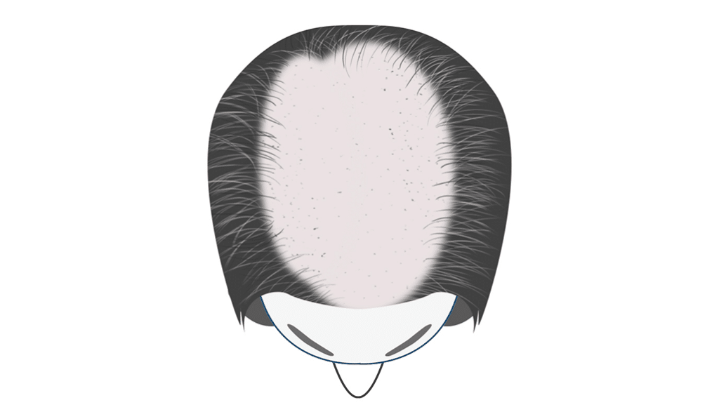 alopecia-Developing-Stage