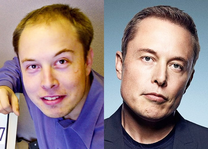 Elon-musk-hair-loss