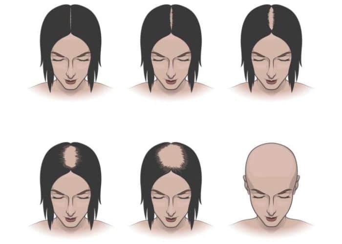 female-hair-loss-stage