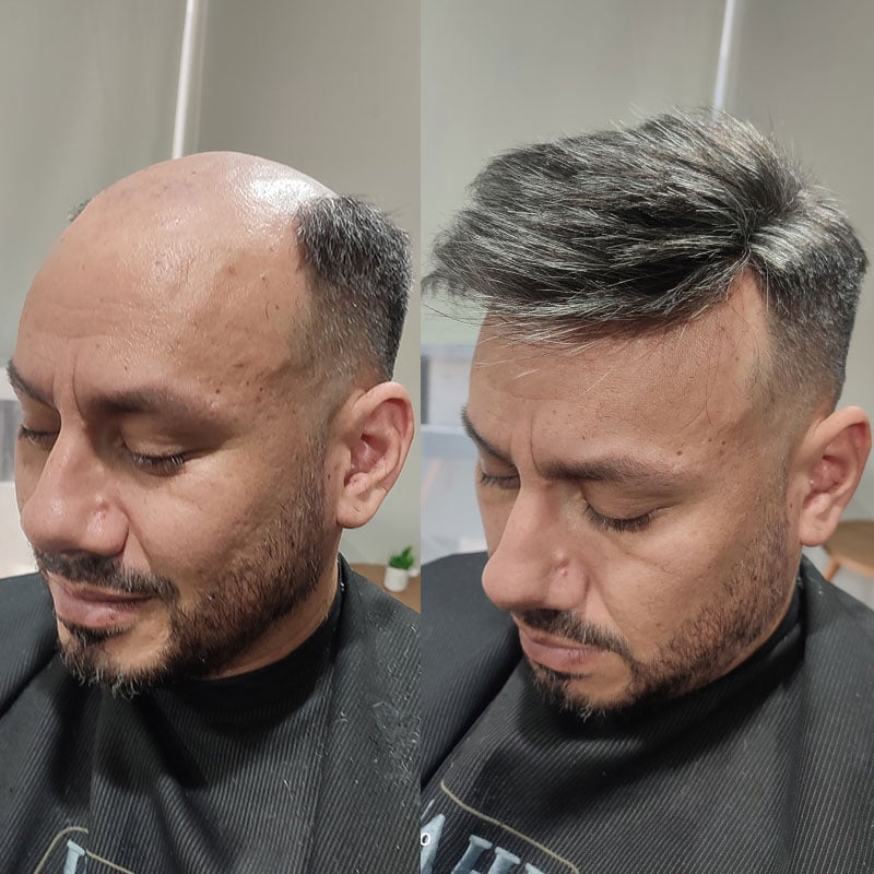 D7-3-DYF hair system before and after