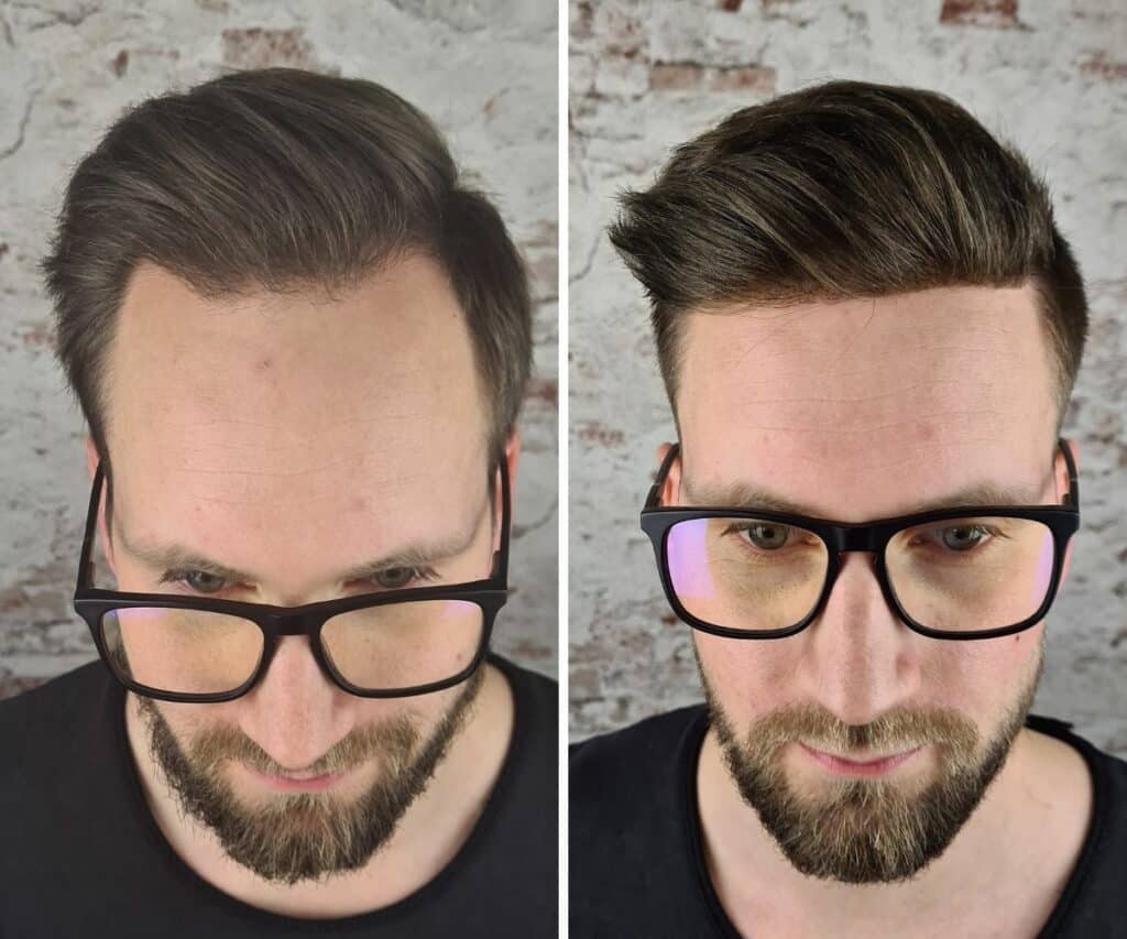 glue on hair for men before and after new times hair client feedback-3