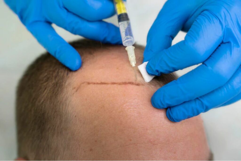 injection after failed hair transplant