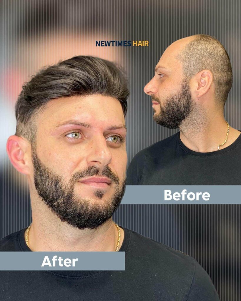 haircuts-for-balding-men-before-and-after