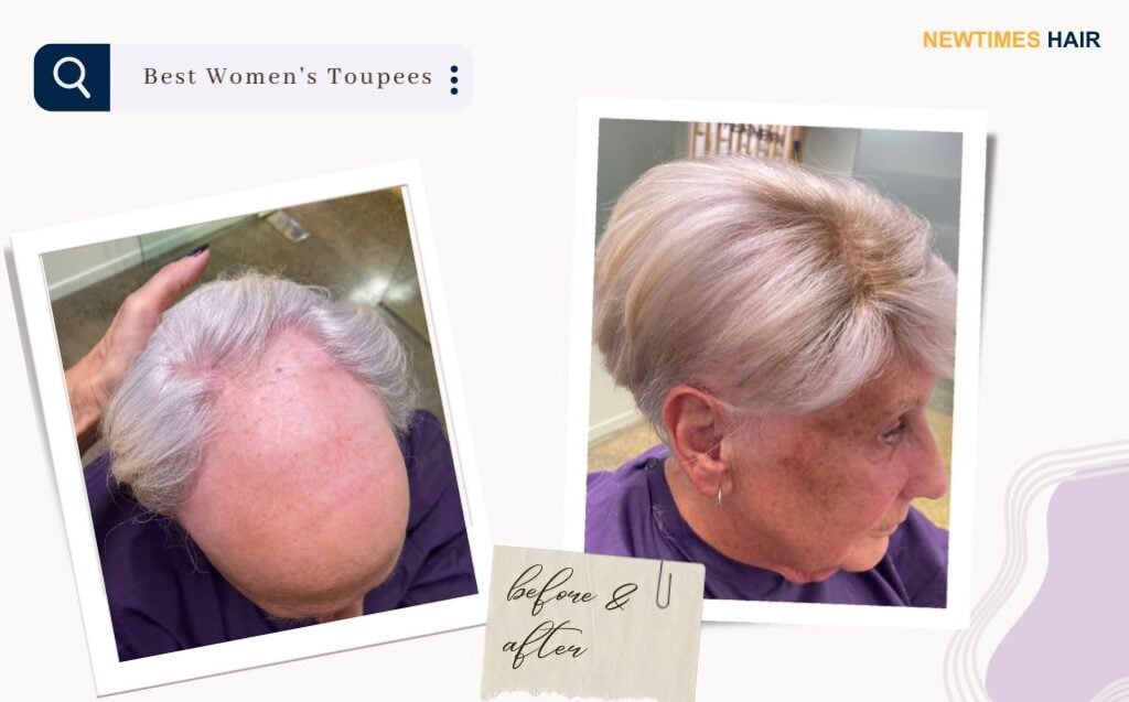 Before and after an elderly lady had one of the best hair systems for women installed to her head and the hair styled