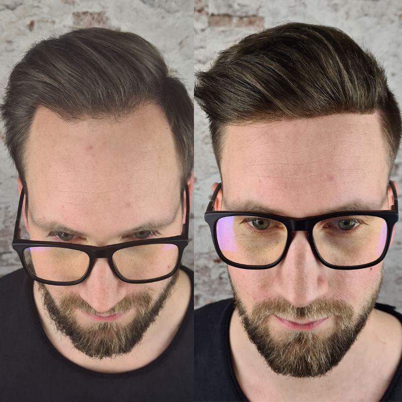 hairline hair systems before and after new times hair